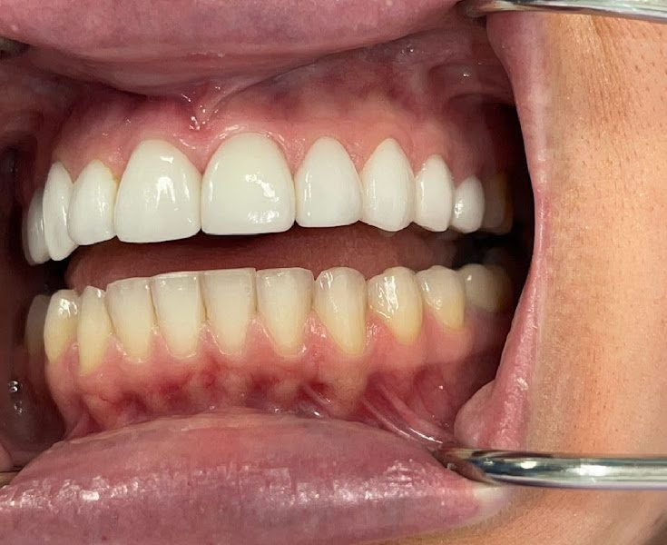 Veneers and Lumineers
