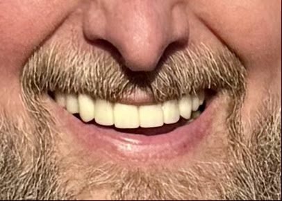 1899 Dental Implant 5
