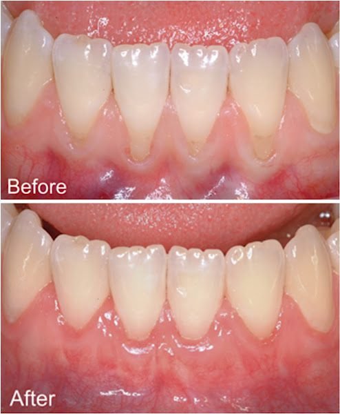 Affordable Dental Implant Excellence/ Implant Dentures/ TMJ and Headaches/ Thomas E. Bramanti, DDS, PHD, INC 2