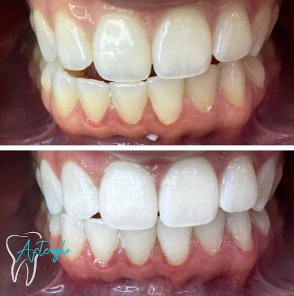 Afterglo Organic Teeth Whitening Studio