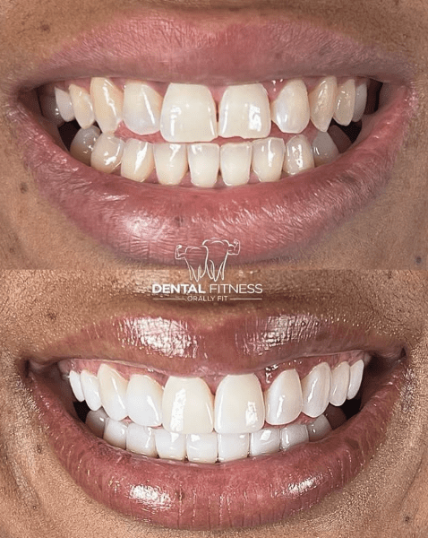 Dental Fitness - Miami