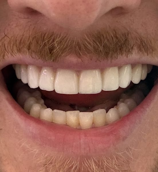 Dental Implants Miami Beach: Dr. Howard Abrahams, DMD, MScD 6