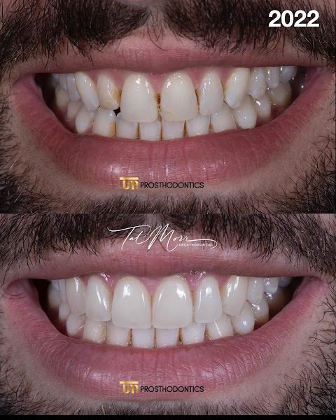 TM Prosthodontics - Dr. Tal Morr 5