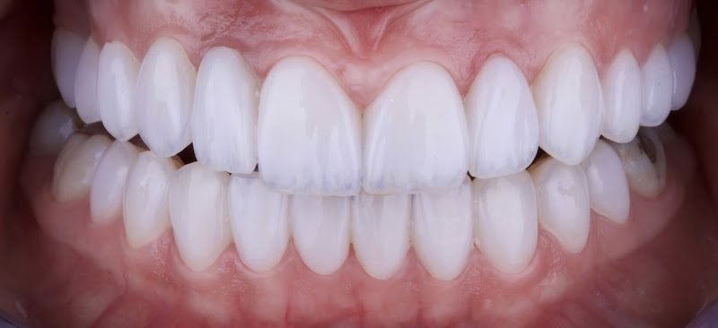 Veneers Orlando