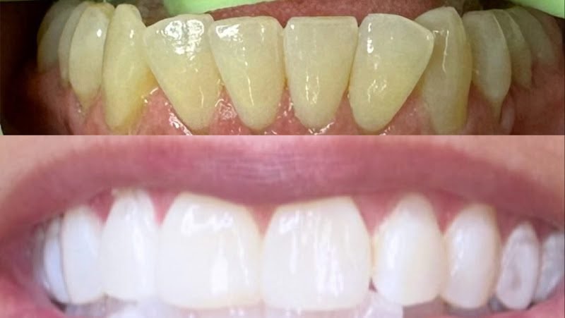 Smile and Glow Teeth Whitening