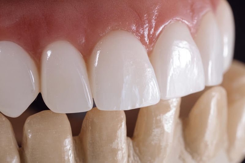 Care Dental Implant 2