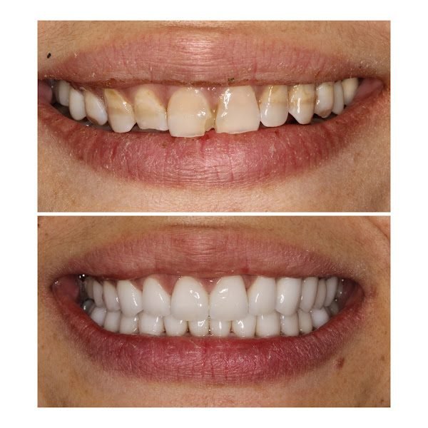 Care Dental Implant 3