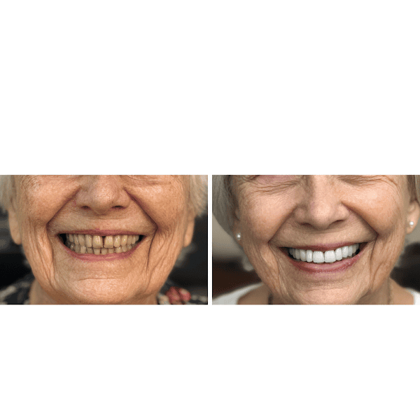 New Smile Dentures - Boise 3