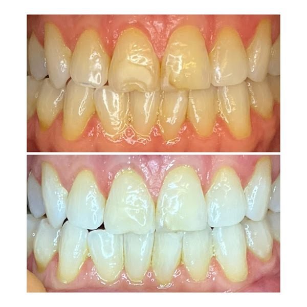 We Whiten Teeth Whitening
