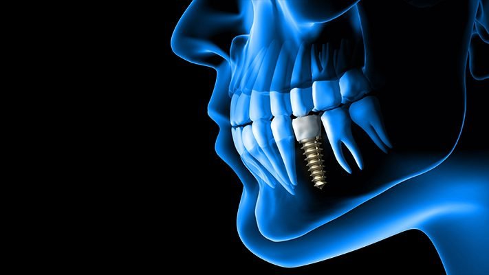 Dental Implants GPS 6